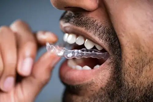 Invisalign